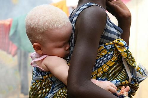 albino en africa