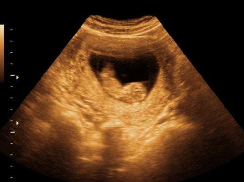 ecografia de un feto