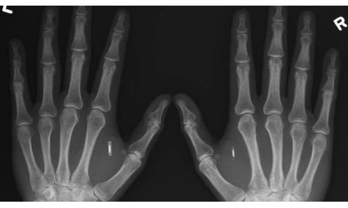 radiografia de chips en las manos