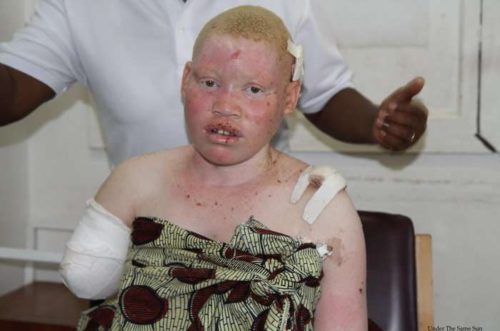 albina ataca en malawi