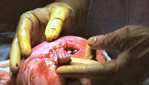 cirujano con mano de bebe antes de nacer aborto